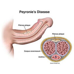 Peyronie's Disease Understanding Remedies and FAQs