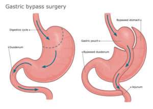 Everything You Need to Know About Bariatric Surgery